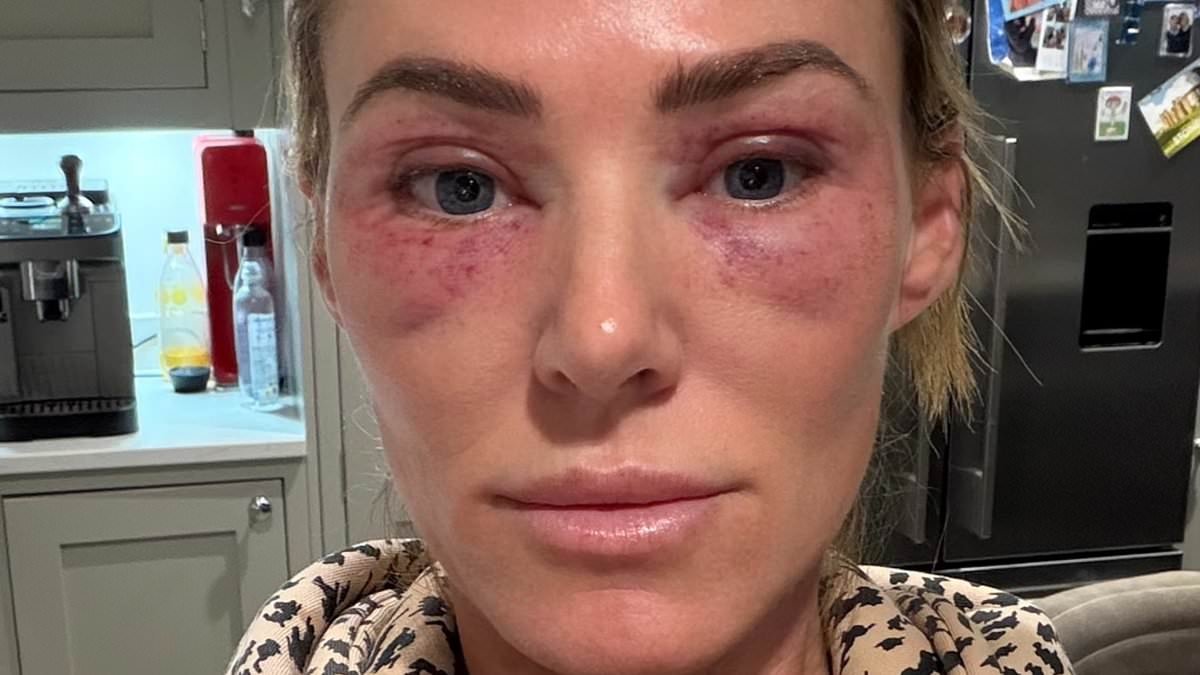 Finally, there IS a cure for saggy eyelids and wrinkly eyebags. People now think I'm a decade younger thanks to a revolutionary treatment that lasts years, says SARAH LINDSAY